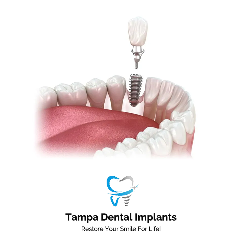Single Dental Implant