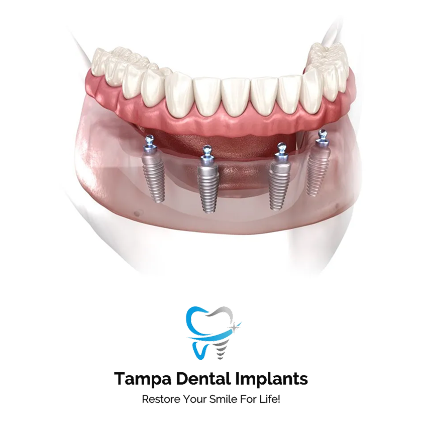 All-On-4 Zirconia